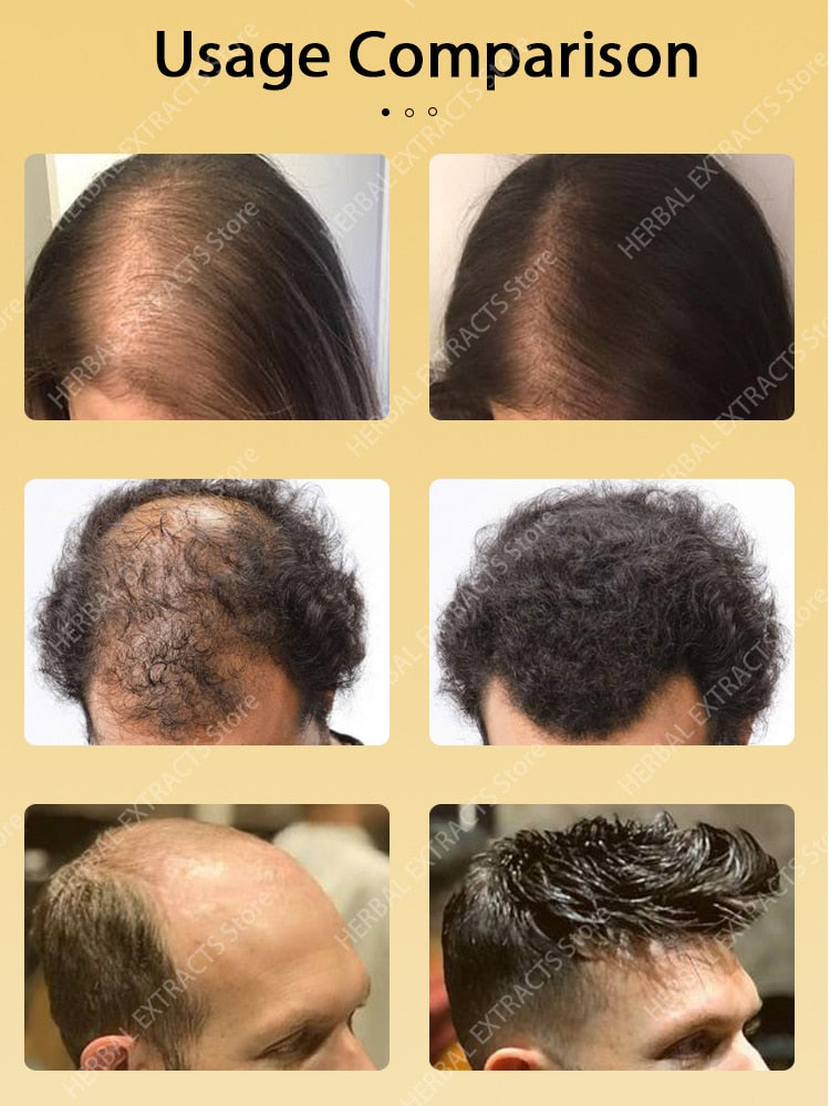 Hair Growth Regrowth Products Oil Anti Hair Loss